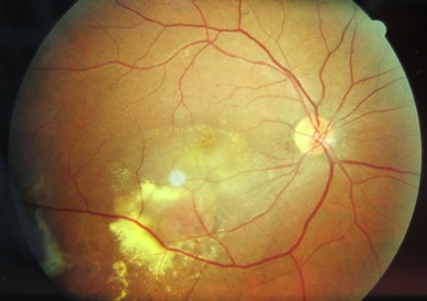 wet macular degeneration