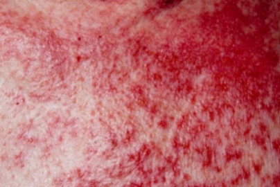 basal skin cancer