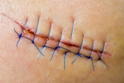 skin cancer reconstructive surgery