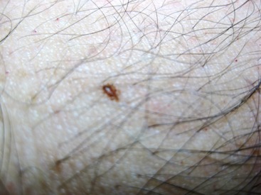 skin cancer signs