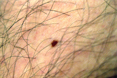 symptoms of skin cancer