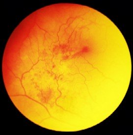 Dry Macular Degeneration