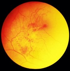 macular degeneration