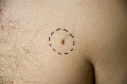 malignant melanoma skin cancer