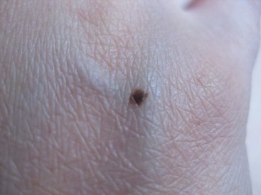 melanoma skin cancer