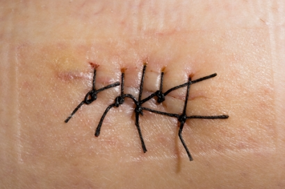 skin cancer melanoma