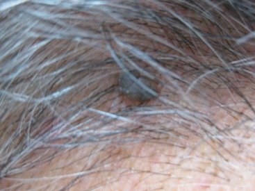 skin cancer moles