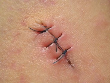 skin cancer reconstruction