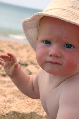 baby with sun hat sunburn face on the beach
